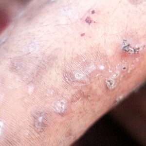 Acarodermatitis - Scabies | frequenz-therapie.com